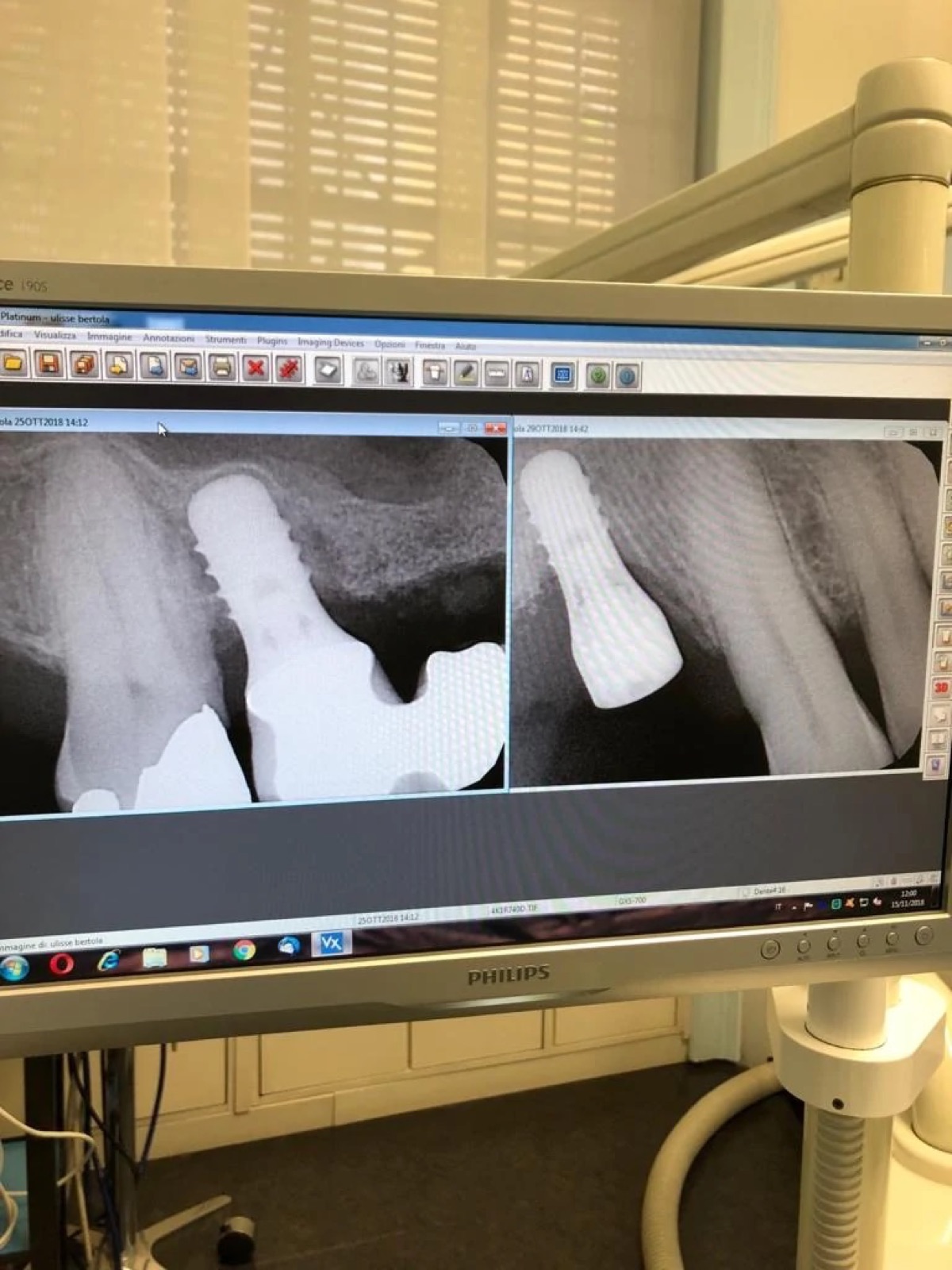 Radiografie digitali di un impianto visualizzate a monitor